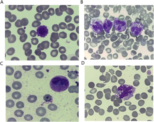 Figure 1. Morphological characteristics of the peripheral blood cells in COVID-19 cancer patients showing: (A) Giant platelets. (B) Neutrophils with toxic granulations, bright mode. (C) Neutrophils with Pelger-Huet abnormality, bright mode. (D) Large sided aggressive looking monocytes with cytoplasmic vacuolations, 100× magnification.