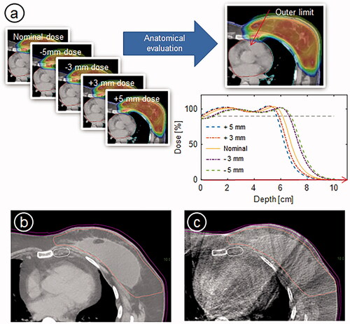 Figure 2. (a) Illustration of the four additional recalculations on artificial CTs and the construction of the structure defining the outer limit tolerance (blue). The dose profiles are extracted along the red arrow and shown in a graph. The black dashed line illustrates the 90% dose level which covers CTVn_IMN. (b and c) show CT and CBCT from a day where the patient was swollen by 5 mm reaching the outer limit structure (pink). The CTVp chest wall contour is red and the CTVn_IMN contour is white.