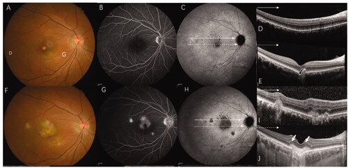 Figure 5. This 36-year-old women with myopia (-5 D in her right eye) complained of decreased visual acuity in her right eye for 5 days and was diagnosed with ICNV via multimodal imaging at her first visit. However, after being treated with anti-VEGF four times and after 6-months of follow-up, the final diagnosis was CNV secondary to MFC. (A–E) Multimodal image of the right eye, which was diagnosed with ICNV at the first visit. (A, B) The fundus photograph and FA only show the CNV lesion. (C) ICGA shows multiple hypofluorescence in the late phases. (D, E). OCT shows normal at superior part of macular (green line) and a CNV legion (yellow line). (F, G) Multimodal image of the same patient at the six-month follow-up. (F–H) The fundus photograph, FA, and ICGA show multiple new lesions. (I) The OCT scan of the same layer with figure D after 6 months shows a well-demarcated dome-shaped homogenous lesion (red arrow) and other new lesions with choroidal hyperreflectivity. (G) The CNV becomes larger and the "pitchfork sign" (yellow pointed arrow) is visible. Thus, the final diagnosis was CNV secondary to MFC. CNV: choroidal neovascularization; MFC: multifocal choroiditis; ICGA: indocyanine angiography; OCT: optical coherence tomography; FFA: fundus fluorescein angiography.