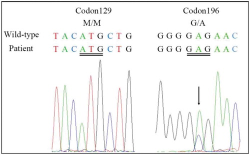 Figure 1. DNA sequencing of the PRNP gene.Compared with the standard sequence, the substitution of cytosine with adenine at codon 196 of the PRNP gene results in the substitution of alanine for glutamate (E196A). The PRNP polymorphism of codon 129 was 129M/M homozygous.