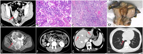 Figure 1. (A) initial diagnosis. (B and C) Haematoxylin and eosin staining of the primary tumour revealed endometrioid adenocarcinoma with squamous metaplasia (magnification ×200) and high grade endometrial mesenchymal sarcoma (magnification ×200). (D) formalin-fixed resected specimen. (E) Recurrence of abdominal and extensive pelvic metastases. (F) The bowel is dilated and an air-liquid plane can be seen, suggesting intestinal obstruction. (G and H) Two months after six cycles of chemotherapy and targeted anti-angiogenic therapy, the patient was found to have liver and lung metastases.
