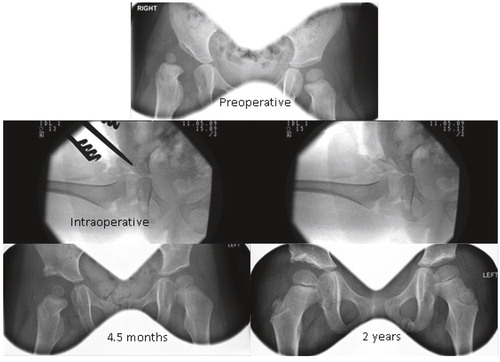Figure 1. Comparison of preoperative and postoperative radiographs at 4.5 months and 2 years.