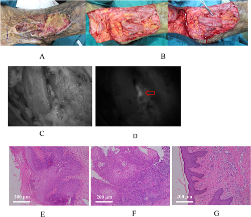 Figure 3 A male with scar carcinoma of left inguinal region and thigh, receiving radical resection under intraoperative real-time ICG fluorescence imaging. (A) The gross appearance of the tumor; (B) The gross appearance of the wound after tumor resection; (C) Visible light image of the wound under intraoperative imaging; (D) Fluorescence image of the wound under intraoperative imaging. Red arrow indicates residual fluorescent signals; (E) The HE staining of the biopsied tissues in the superior margin of the wound after tumor resection; (F) The HE staining of the biopsied tissues in the outer margin of the wound after tumor resection; (G) The HE staining of the biopsied tissues in the medial lower margin of the wound after tumor resection. The scale bars indicate 200 μm.