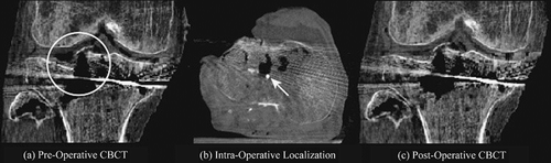 Figure 5. (a) Example coronal image obtained after fracture reduction and placement of a KW in case 2. (b) Localization of the small, displaced fragment was performed using an aluminum KW. The displaced fragment was localized antero-lateral to the KW tip, as shown in the example axial CBCT image. (c) The displaced fragment was manipulated in relation to the aluminum KW, and a near-perfect reduction of the articular surface was achieved under CBCT guidance.