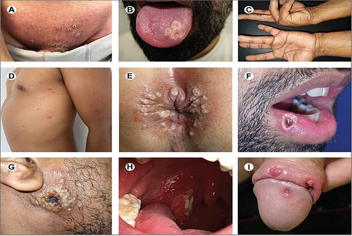 Figure 1 Clinical presentation of confirmed human mpox virus cases in Spain, adapted from Tarin-Vicente et al, with permission of the authorCitation8 (A) Pustules in the genital and pubic area, initially umbilicated, now with necrotic crusts and a central dip. (B) Three merging pustular lesions with indented centers on the left side of the tongue’s top surface. (C) Small, hard vesicles on the thick skin of the palms. (D) Mixed group of bumps, pustules, and indented pustules with redness around them on the side of the chest and left arm. (E) Pustules arranged in a circle around the anus and nearby skin. (F) A pustular lesion with a crusted center on the inside part of the lower lip near the right corner of the mouth. (G) Initial infection site with a large, crusted sore on the right cheek. (H) The right tonsil at the back of the throat is red, swollen, and has a covered ulcer. (I) Various-sized lesions in different stages on the head and covering of the penis, with swelling around the larger sore.