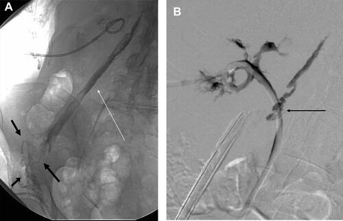 Figure 2 (A) Fluoroscopic image following contrast injection via a nephrostomy catheter demonstrating opacification of a psoas abscess cavity (white arrow) via a sinus from the pyeloureteric junction and opacification of multiple abscess-cutaneous sinuses in the groin (black arrows). (B) Digital subtraction pyelography during contrast injection of a nephro-ureteral stent in the same patient demonstrating opacification of a psoas abscess cavity via a sinus (black arrow) at the level of the pyeloureteric junction. Markedly scarred, ragged calyces and a severely contracted renal pelvis are evident in the affected upper pole moiety.