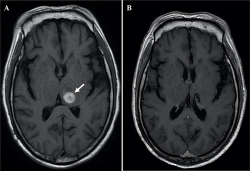 Figure 2 MRI scans displayed a metastatic lesion in the left thalamus before and after dacomitinib treatment. (A) Axial MRI scan showed a 2.2×1.6 x 1.5 cm lesion with mixed signal intensity (arrow), suggestive of a hemorrhagic metastatic lesion. (B) Axial MRI scan revealed complete remission of the previously noted metastatic lesion.