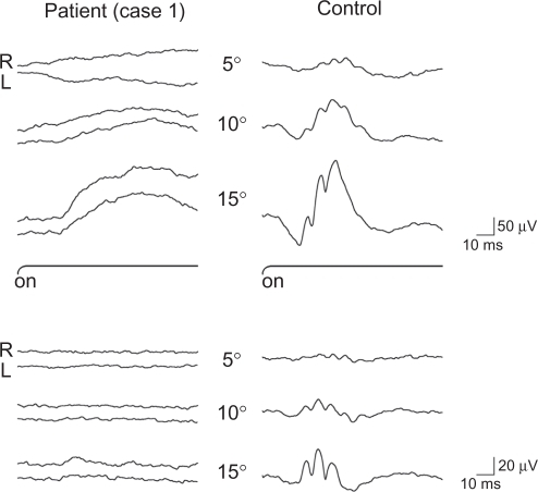 Figure 5 Focal macular electroretinogram (ERG) (above) and oscillatory potentials (below) recorded from case 1 (left) and normal subject (right). The focal macular ERGs from the patient are clearly smaller than the responses from the normal eye. These ERGs were elicited by 5′, 10′, and 15′ stimulus centered on the fovea. The black bars show the stimulus duration (100 ms).