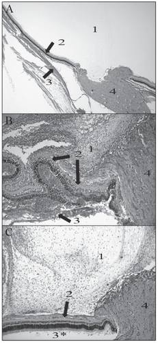 Figure 4 Representative histology pictures of an uninfected eye (A; 20X magnification) and eyes infected with strains producing high (B; 40X magnification) or low (C; 40X magnification) PLY activity. 1 is vitreous; 2 is retinal layers; 3 is choroid; 4 is optic disk. (A) Normal vitreous (1), retina (top arrow), and choroid (bottom arrow) were observed in an uninfected eye. (B) Damage and inflammation of the retina were observed (top two arrows). The choroid had become separated from the retinal layers by PMNs (bottom arrow). Severe inflammation was observed in the vitreous (1). (C) Only moderate inflammation was observed in the vitreous (1). Minor inflammation was observed in the retinal layers (arrow).