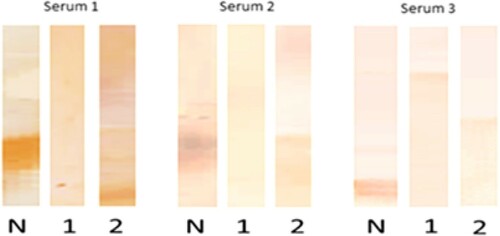 Figure 5. Immunoblot of casein conducted among three patients: native casein (N), heated casein (1), hydrolysed casein (2).