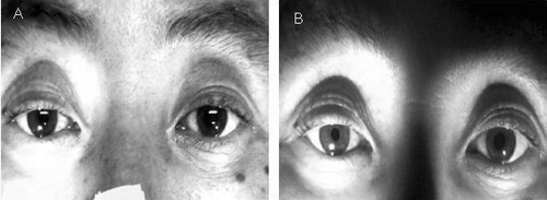 FIG. 1. Pupil size: showing anisocoria aggregation in dark-room conditions. A) Right pupil size 2–3 mm, left pupil size 3 mm in bright-room conditions. B) Left pupil size 4 mm in dark-room conditions.