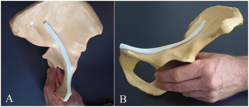 Figure 4. A synthetic rapid prototype model of the mean ROI, featuring an excellent fit to an arbitrary, customary SYNBONE® hemipelvis model. (A) Anterior-posterior (inlet) view. (B) Lateral view.