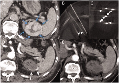 Figure 3. Axial contrast-enhanced computed tomography (CT) images. (A) T1b renal tumor (maximum diameter: 65 cm) on upper pole of the left atrophic native kidney (blue arrows), using seven cryoprobes under CT guidance. Incremental axial (B) and coronal (C) CT images during the procedure show 15 mm spacing between each probe (double-headed arrows). (D) Arterial axial contrast-enhanced CT image shows a LTP at 3 months (white arrows). (E) Axial contrast-enhanced CT shows no macroscopic residue at 3 months after a repeat cryoablation (black arrows).