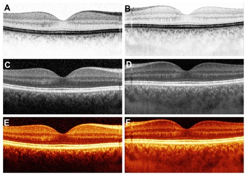 Figure 2 Vertical cross-sectional scan of the right eye through the fovea of a 27-year-old male healthy subject. The display modalities are black/white mode in (A) (conventional) and (B) (enhanced depth imaging); white/black mode in (C) (conventional) and (D) (enhanced depth imaging); and color/heat mode in (E) (conventional) and (F) (enhanced depth imaging). Inverted scans (B, D, and F) show an increased imaging depth of the choroid in all three different display modalities, compared to the conventional scans.