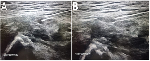Figure 1. Ultrasound guided suprainguinal fascia iliaca block.