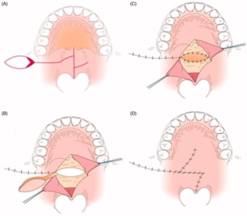 Figure 3. Illustration of Figure 2(A–D). A: The pedicle of the right BMMF is denuded (red area).