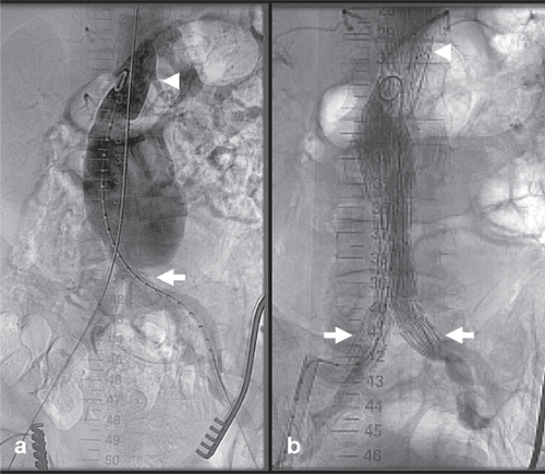 Figure 5 Example of endograft insertion for abdominal aortic aneurysm. (a) An 83-year-old male with an incidental finding of a 6.7-cm infrarenal abdominal aortic aneurysm extending to the aortoiliac bifurcation (white arrow). (b) Aneurysm was successfully excluded with transfemoral insertion of a bifurcated endograft device (Zenith AAA Endovascular Graft, Cook Medical, Bloomington, United States). Note the suprarenal fixation of the device (white arrowhead) and the distal landing in the common iliac arteries (white arrows) to minimize risk of endoleak.