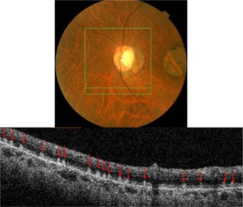 Figure 14 The B-scan line on the fundus photograph (top) has the same width as the B-scan SD-OCT image (bottom) demonstrating the appearance of white deposits (red arrows) in fundus albi.