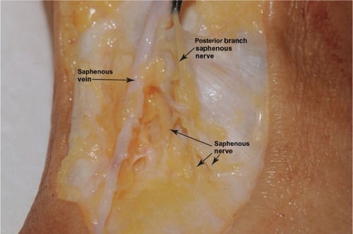 Figure 1 Gross dissection of medial ankle.