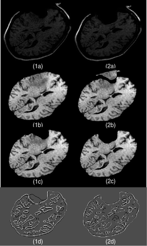 Figure 16. Two-dimensional experimental results for modeling of the second resection in Case 3. (1a) The third iMR image. (2a) The fourth iMR image. (1b) The image resulting from brain shift and first resection modelings, identical to Figure 13(2b). (2b) Deformation of (1b) using the surface displacement field of the biomechanical model, computed via XFEM. (We say “surface” since we are working in two dimensions.) (1c) The image resulting from brain shift and first resection modelings, identical to Figure 13(2c). (2c) Deformation of (1b) with resection, performed by masking (2b) with the brain region segmented from the fourth iMR image (2a). (1d) Juxtaposition of Canny edges of (1c) and the brain part of (2a). (2d) Juxtaposition of Canny edges of (2c) and the brain part of (2a).