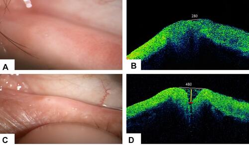 Figure 3 (A and B) Before treatment: Slit lamp examination showed barely visible punctum and stuffed appearance. Anterior segment optical coherence tomography (AS-OCT) image revealed outer punctal diameter (OPD) of 280 µm (white line) with lost punctal depth (PD). (C and D) One month after treatment: Slit lamp examination showed decreased punctal edema with clear visible punctal opening. AS-OCT image revealed increased OPD to 480 µm (white line) and restoration of the PD (yellow line) associated with marked clinical improvement.