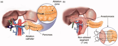 Figure 1. (a) Endolumnal thermal ablation (ETHA) of the main pancreatic duct conducted using the ClosureFast system (Medtronic, Mansfield, MA, USA). (b) Once completed the ablation zone around the main pancreatic duct, pancreatico-enteric anastomosis was conducted.