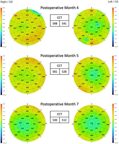Figure 3 Pachymetry at 4 months post-PRK (top), 5 months post-PRK (middle), and 7 months post-PRK (bottom).