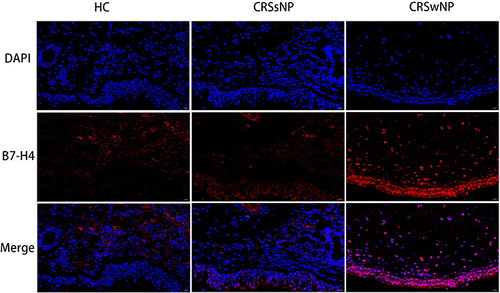 Figure 4 Immunofluorescence and B7-H4 protein expression in the tissue among three groups. Representative immunofluorescence images of HC, CRSsNP and CRSwNP (magnification x400).