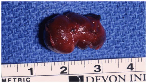 Figure 8 Final specimen of insulinoma as shown in Figure 4, 5, 6, and 7.