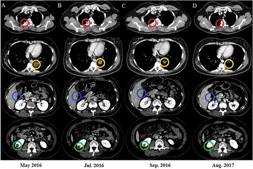 Figure 3. Nivolumab and radiation result in tumor regression.Axial CT images are shown corresponding to the treatment timeline. Panel A represents the status before treatment with nivolumab and radiation. Panel B shows images 1 month later after radiotherapy. The CT scan revealed tumor shrinkage in irradiated (red circle) and pulmonary metastasis (yellow circle) and stable lesions in the liver (blue circle) and kidney (green circle). Panel C shows tumor regression in the irradiated focus and distant disease outside the radiation field. The response was durable, as shown in Panel D.