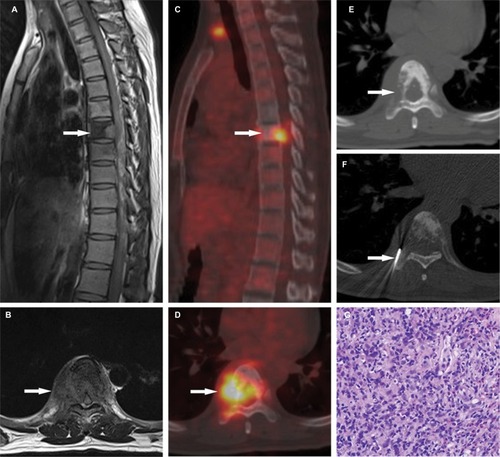 Figure 4 A 62-year-old woman with compression fracture in the sixth thoracic vertebra (T6). (A, B) Magnetic resonance imaging shows the posterior cortical bulging on sagittal view (A, arrow indicated) and paraspinal mass formation on axial view (B, arrow indicated). (C, D)18F-FDG PET/CT imaging shows increased FDG uptake in the soft tissue adjacent to T6 (arrow indicated, SUVmax = 4.90). (E, F) CT-guided percutaneous biopsy is subsequently performed and the T6 paraspinal mass (arrow indicated) is chosen as the biopsy target (E). Axial noncontrast CT image shows the biopsy needle (arrow indicated) positioned within the right side of the paraspinal mass (F). (G) Histological examination showed presence of inflammatory infiltrates and interstitial expansion with no evidence of malignancy.Abbreviations:18F-FDG, 2-[fluorine-18]-fluoro-2-deoxy-D-glucose; PET, positron emission tomography; CT, computed tomography; SUVmax, maximum standardized uptake value.
