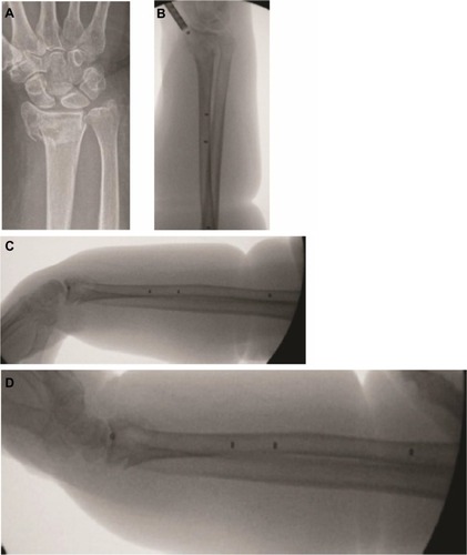 Figure 1 The PBSS utilized in a distal ulna fracture.