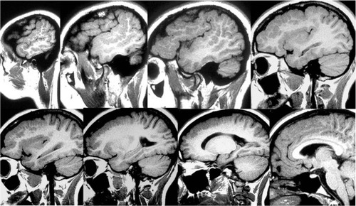 Figure 3 Spin-Echo T2-weighted sagittal projections on magnetic resonance imaging study of the brain.