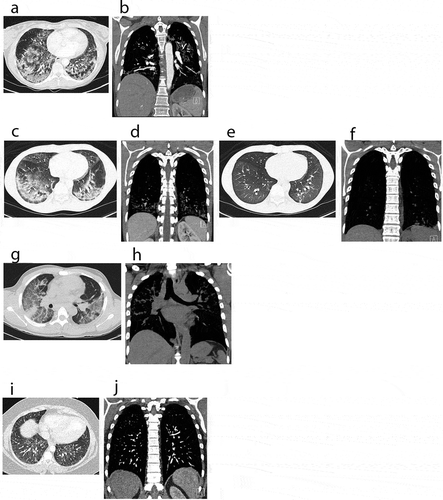 Figure 2. CT scans: computerized tomography of chest, showing a spectrum of EVALI in axial and coronal views. (a, b) Chest CT images of case 1 on admission, pre-treatment. (a) revealed bilateral ground glass opacities and interstitial infiltrates. (b) revealed prominent right hilar lymph nodes and an enlarged intrathoracic node. (c–f) Chest CT images of case 2. (c, d) (on admission, pre-treatment) demonstrating bilateral ground glass infiltrates. (e, f) (steroid day 4) showing significant improvement of lung infiltrates bilaterally. (g, h) Chest CT images of case 3 on admission, pre-treatment. (g) demonstrating diffuse patchy ground-glass opacities bilaterally. (h) showing mediastinal lymphadenopathy and interstitial infiltrates bilaterally. (i, j) Chest CT images of an asymptomatic patient with vaping history. CT images showed mild diffuse ground-glass opacities bilaterally