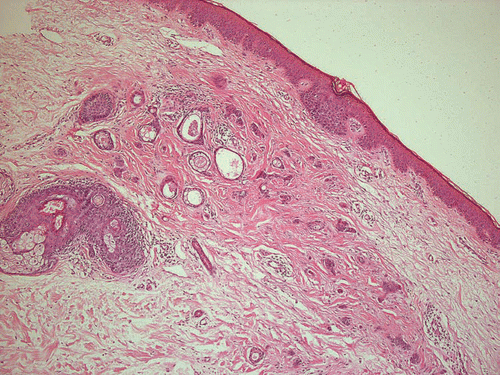 Figure 4 Facial syringoma of patient #6 with fibrosing stroma reaction, H&E, ×100.