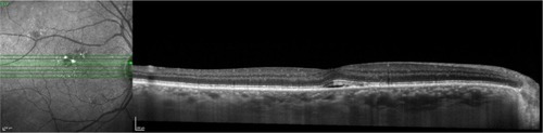 Figure 64 Spectralis® optical coherence tomography image (Courtesy of Roberto Gallego-Pinazo, MD).