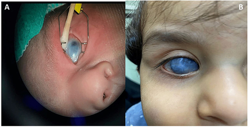 Figure 1 (A) Examination under anaesthesia of the patient showing evidence of sclerocornea, aniridia, and aphakia (age 2 weeks old). (B) Presentation of the patient with sclerocornea, aniridia, and aphakia (age 4 years old).
