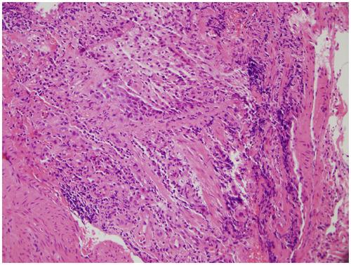 Figure 4 Lung biopsy showing lymphocytic bronchiolitis in the setting of acute lung transplant rejection.