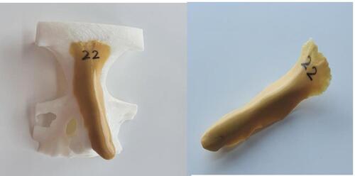 Figure 1 Epoxy-designed nasal implant based on a 3D skull.