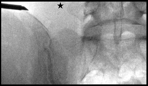 Figure 11 Trocar tip marks skin entry site when targeting the S1 pedicle. Once a Ferguson view is obtained, extend an imaginary line from the L5 transverse process (star) to the ipsilateral iliac crest and this marks the entry site of the introducer cannula assembly.