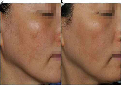 Figure 4. Case 3: A 38-year-old woman with melasma. (a) Before treatment, (b) After treatment.