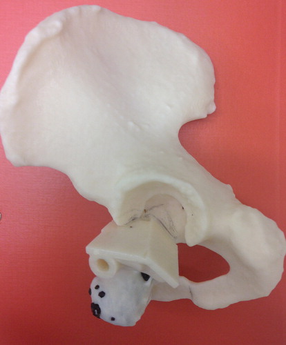 Figure 2. Custom osteotomy guide fitted to the model of the pelvis.