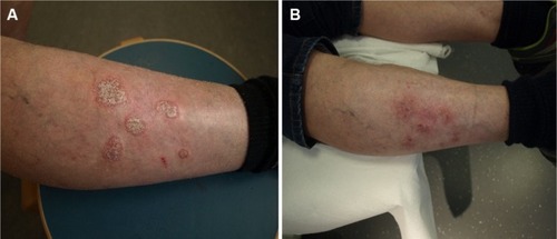 Figure 3 (A) Hyperkeratotic psoriasis on the anterior legs in a 71-year-old male before treatment with Cal/BD aerosol foam. (B) Psoriatic lesions after 4 weeks’ treatment with Cal/BD aerosol foam.