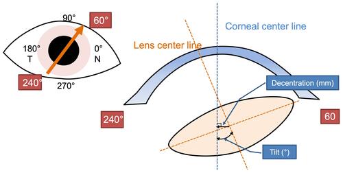 Figure 1 Definition of decentration and tilt in anterior segment optical coherence tomography. The yellow dotted line indicates the lens center line. The blue dotted line indicates the corneal center line (vertex normal).