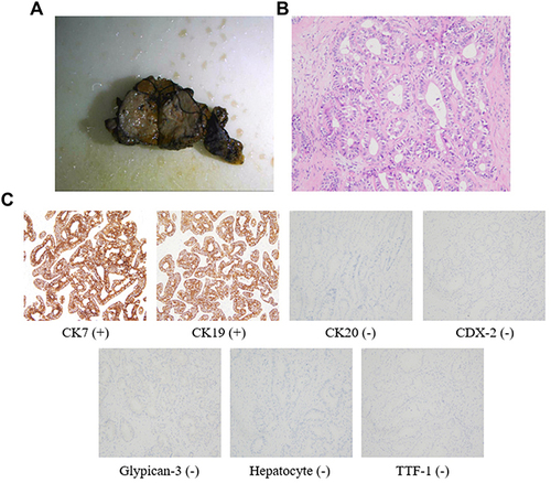 Figure 2 Excised tissue and postoperative pathological examination of the patient. (A) Excised gallbladder and liver tissue: a gray mass of 6 cm × 4.5 cm × 3 cm in size on section view. (B) Pathological examination: hematoxylin and eosin (H&E) stain, original magnification ×200. (C) Immunohistochemical results: CK7 (+); CK19 (+); CK20 (-); CDX-2 (-); Glypican-3 (-); Hepatocyte (-); TTF-1 (-).