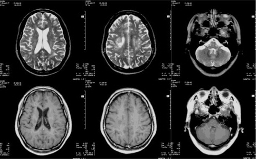 Fig. 3 Brain MRIs 1 year after the disease: the lesion number was similar to that originally observed, but the signal intensities of the lesions had significantly decreased, the boundaries were clear, and lesions exhibited no enhancement.