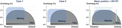 Figure 6. This figure visualizes a “top view” of the PE bearing and tibial component of the Oxford Medial UKA. The figures are based on the assumption that the bearing is kept parallel with respect to the vertical wall. Extreme cases of bearing overhang are visualized in Case 1 and 2. The mean bearing position for all patients with 95% prediction interval is visualized in the right panel. Case 1 represents the patient with 5 mm medial overhang and case 2 represents the patient with 5 mm posterior bearing overhang. The graphs are computed using the femorotibial contact point and the exact ratio between the size of the bearing and tibial component.