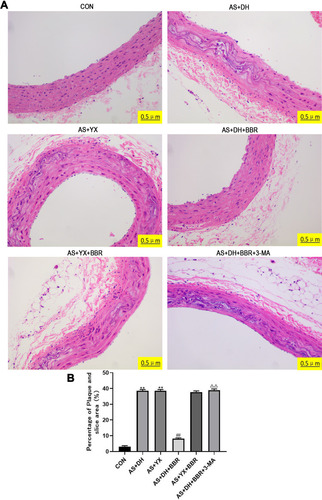 Figure 1 The histology analysis of the rat aortic tissues. (A) HE staining of the rat aortic tissue sections (200×). (B) Plaque percentage in the section area. Note: The nuclei are blue, and the lipid plaques and foam cells are white. All the experiments were repeated for 5 times. **P < 0.01 vs CON group; ##P < 0.01 vs AS + DH group; Δ ΔP < 0.01 vs AS + DH + BBR group.