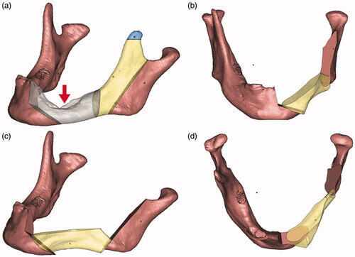 Figure 3. The upper left picture (a) shows the 3D simulation of the unoperated mandible. Pictures (b–d) demonstrates the rotation of the graft. Gray – area to be resected; yellow – anterior ramus graft; blue – remnant coronoid bone; pink – remaining native bone. The red arrow points to the pathological defect.