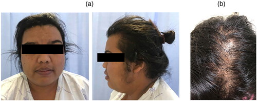 Figure 1. Findings of virilization. (a) Hirsutism of face. (b) Male-pattern baldness (with permission from the patient).